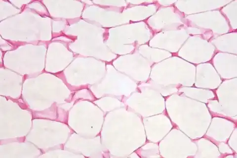 What Is Hypoplastic Myelodysplasia? Medical Definition