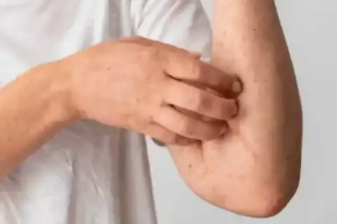 Breast Lift